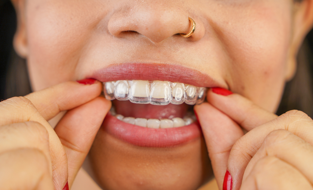 Invisalign Candidates